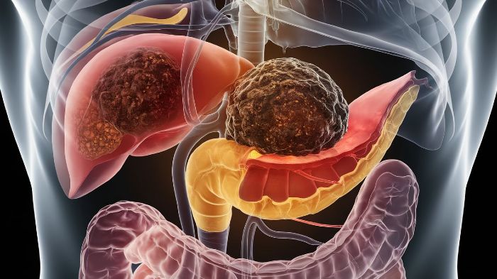 Early signs of pancreatic cancer most people ignore