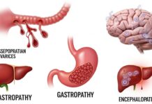 Liver cirrhosis complications in alcohol use disorder Liver cirrhosis complications in alcohol use disorder