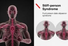 Rare neurological disorder stiff-person syndrome overview Rare neurological disorder stiff-person syndrome overview